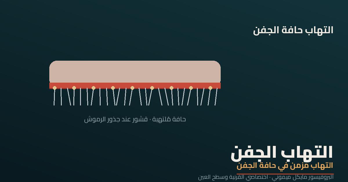 التهاب الجفن