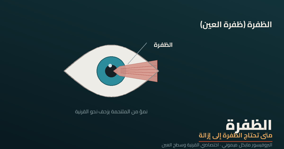 الظفرة