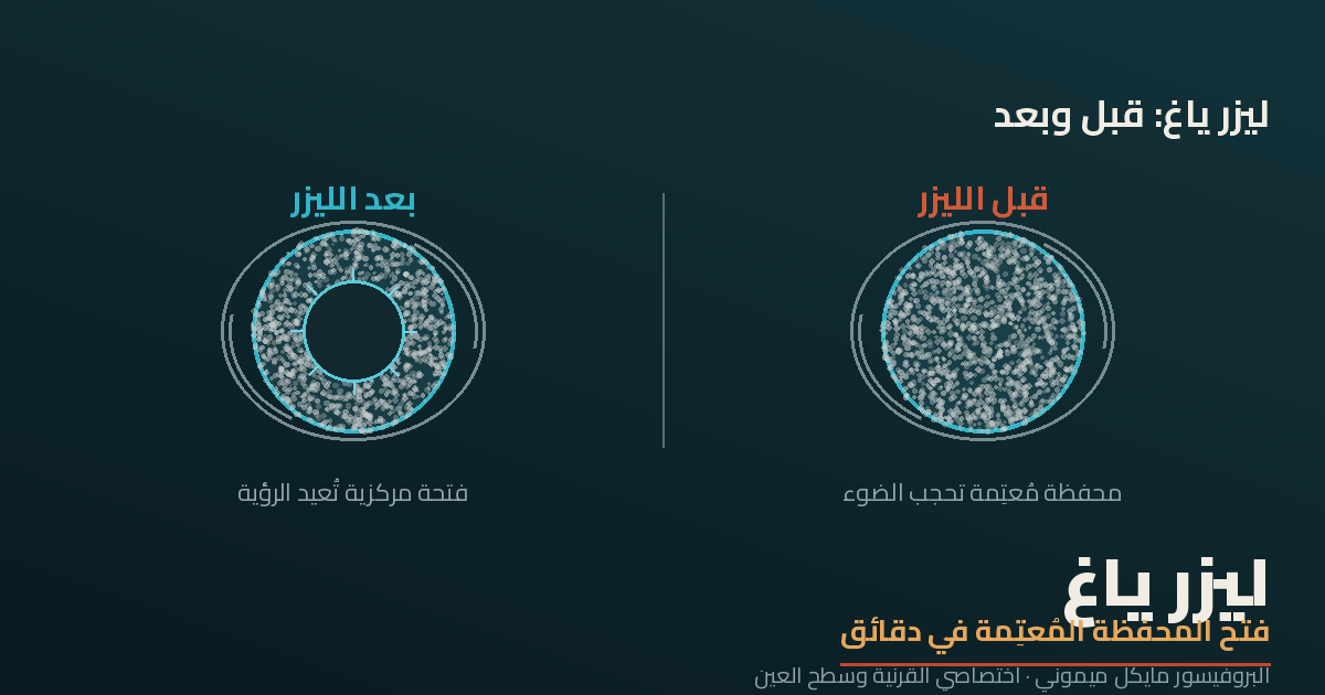 ليزر ياغ (بضع المحفظة الخلفية)